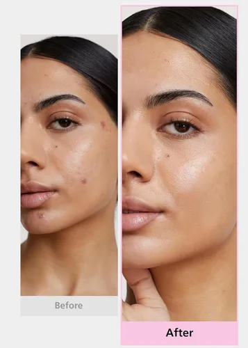 Vista 4 de EasyDerm - Juego variado de parches para el acné de 4 tipos y herramienta 2 en 1 para reventar espinillas