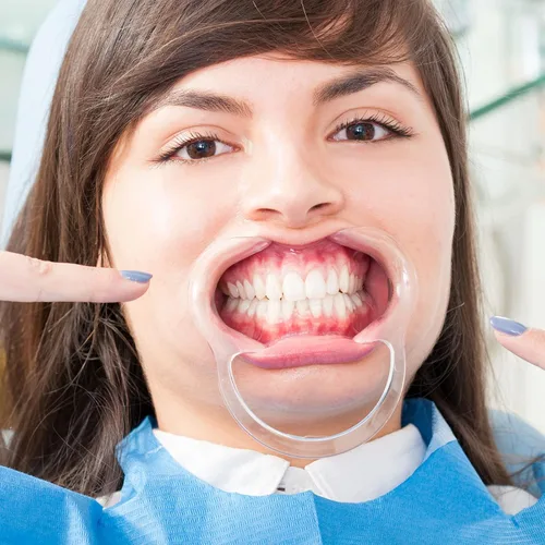 Vista 6 de 10 piezas de retractor de mejillas en forma de C, abridor de boca desechable para blanqueamiento dental de dientes, protector bucal o juego