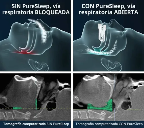 Vista 3 de PureSleep – La boquilla antironquidos original y la solución #1 en todo el mundo