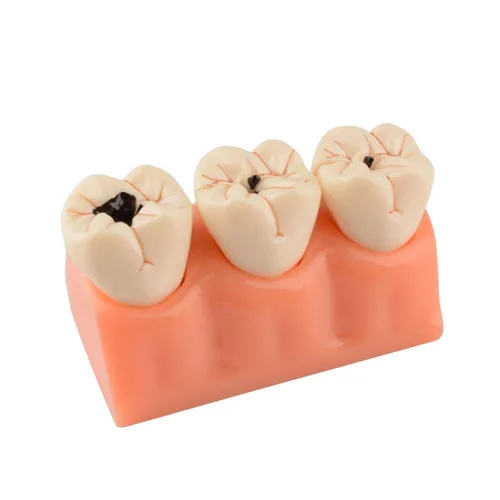 Vista 2 de Modelo de dientes de caries dentales 4 veces modelo de caries dental Caries Comparación bilateral Modelo de patología Dientes para suministros